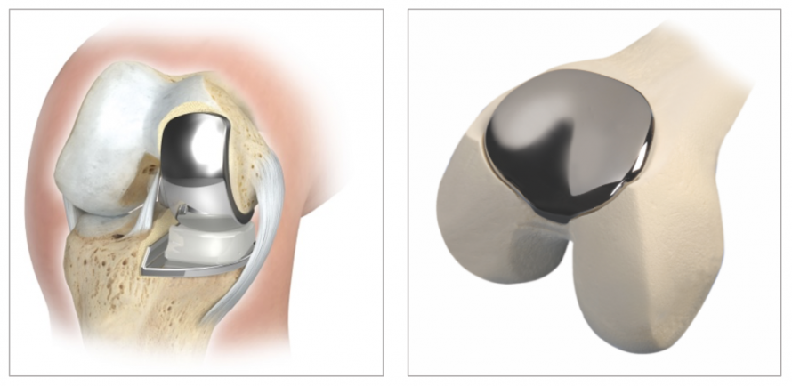 Teilgelenkersatz Knie